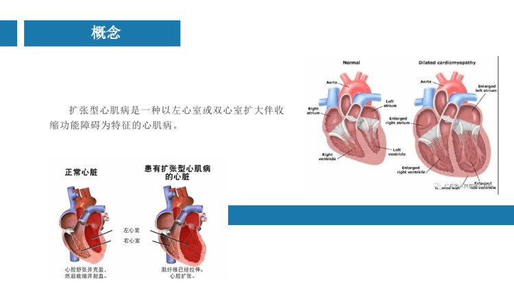 心肌擴張中國最新療法揭秘，創(chuàng)新治療引領(lǐng)未來??