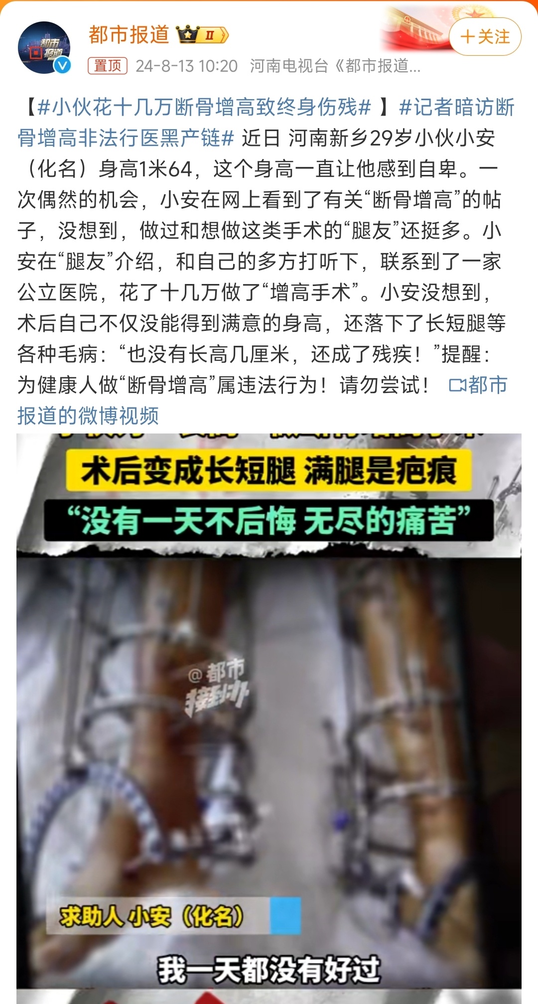 最新斷骨增高,最新斷骨增高技術(shù)，重塑身高的希望之光